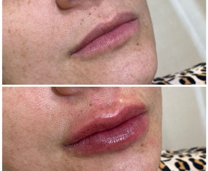 Resultado preenchimento labial — antes e depois
