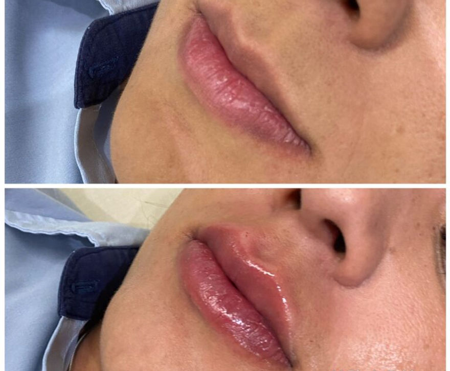 Resultado preenchimento labial 2 — antes e depois