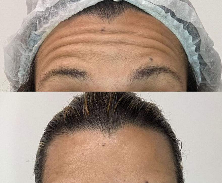 Resultado toxina botulínica — antes e depois